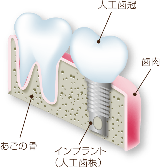 インプラントのメリット