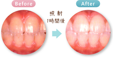 ホワイトニングBefore&After